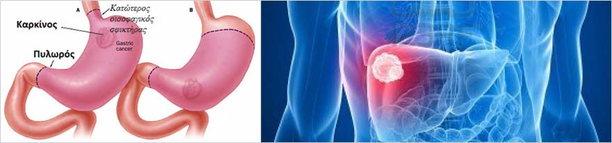 karkinos-stomachou