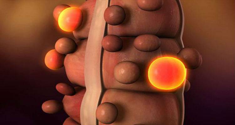 Προσοχή στα εκκολπώματα του παχέος εντέρου για την αποφυγή σοβαρών επιπλοκών