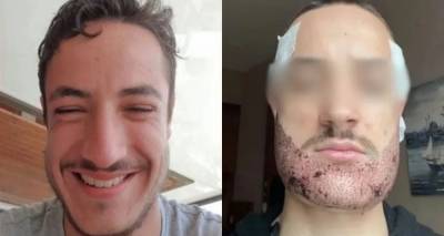 Αυτοκτόνησε Γάλλος φοιτητής μετά από μεταμόσχευση γενειάδας στην Τουρκία