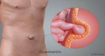 Η ομφαλοκήλη και η λαπαροσκοπική της αντιμετώπιση