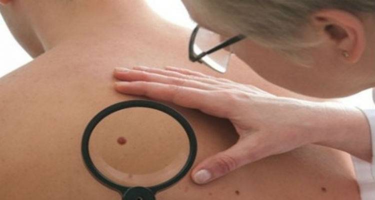 Δωρεάν εξέταση μελανώματος στη Λήμνο