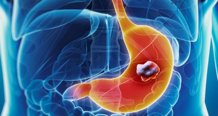 Από τους πιο συχνούς αλλά με πτωτικές τάσεις ο καρκίνος του στομάχου στην Ευρώπη