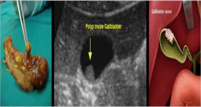 Πολύποδες στη χολή: Μπορεί να είναι και επικίνδυνοι αν δεν χειρουργηθούν