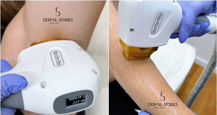 Laser αποτρίχωση: Η οριστική λύση για την ανεπιθύμητη τριχοφυΐα