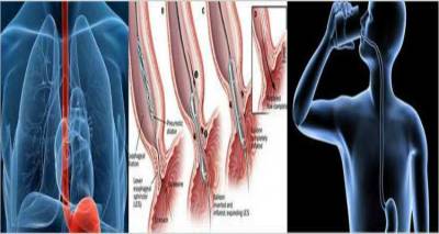 Αχαλασία του οισοφάγου: Μια σπάνια νόσος με έντονη συμπτωματολογία