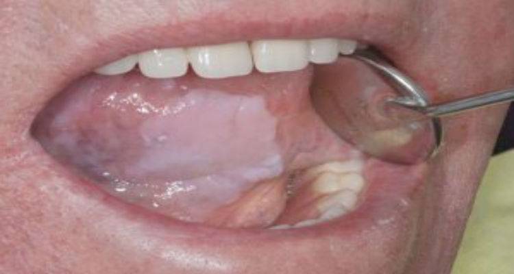 Λέμε ΟΧΙ στο Τσιγάρο, ΟΧΙ στη  Λευκοπλακία